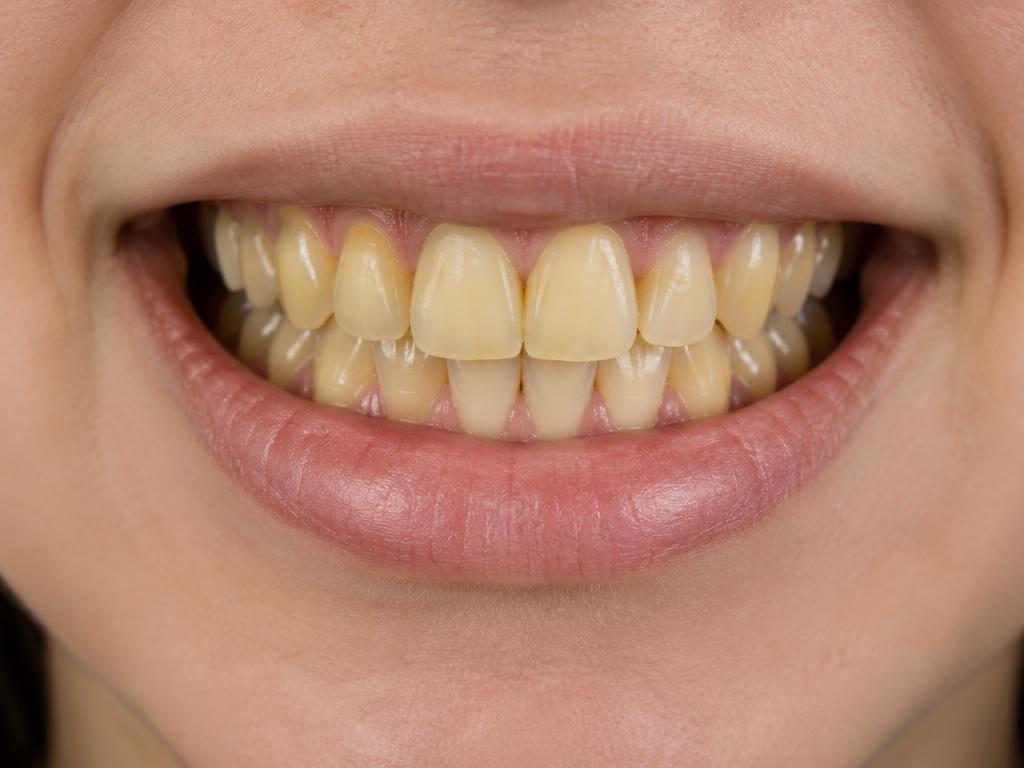 Professional whitening: before treatment